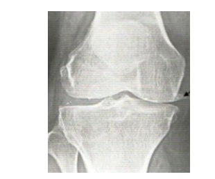 Joint Restore Gummies